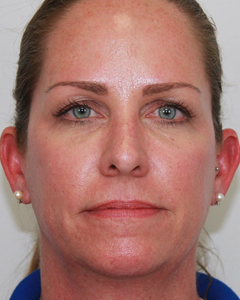 Rhinoplasty Before & After Gallery - Patient 143522143 - Image 1