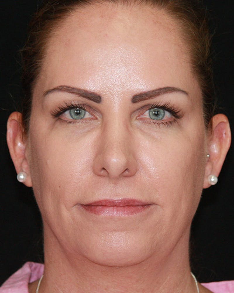 Rhinoplasty Before & After Gallery - Patient 143522143 - Image 2