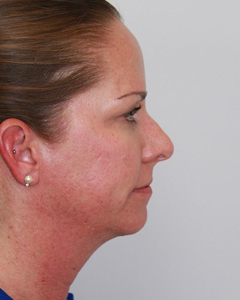 Rhinoplasty Before & After Gallery - Patient 143522143 - Image 5