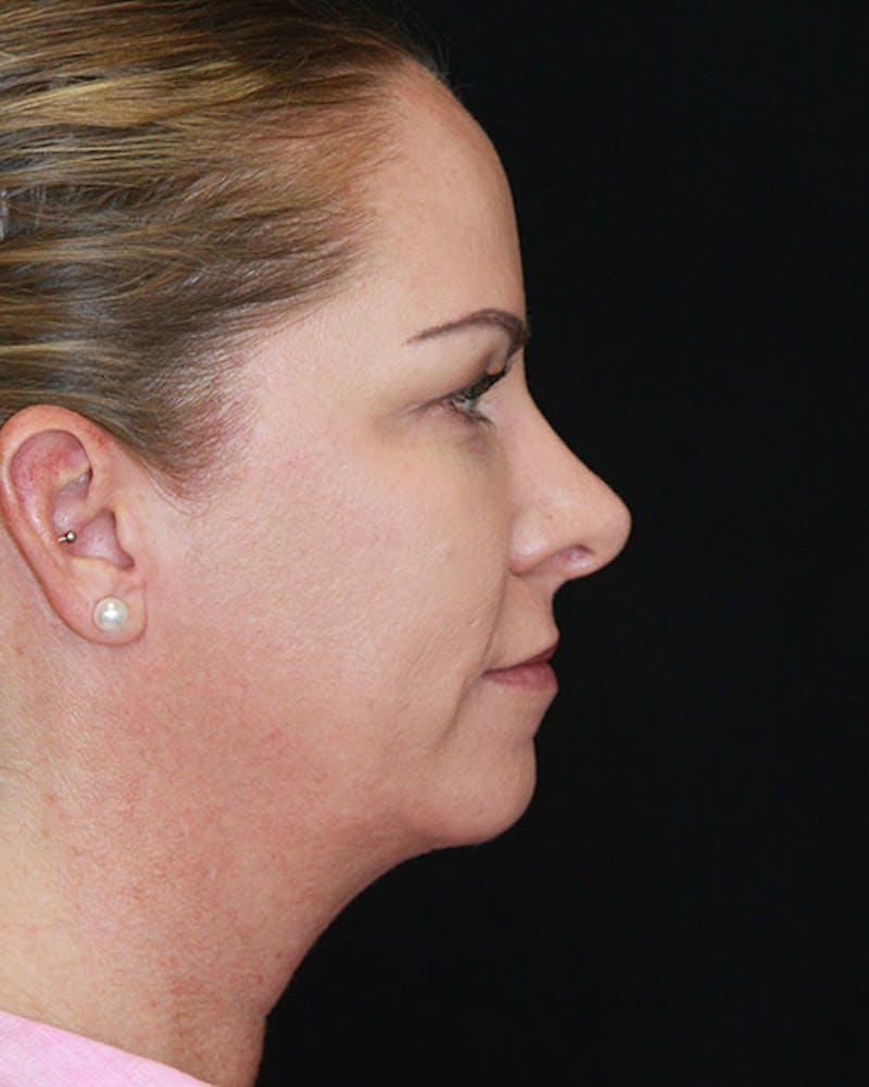 Rhinoplasty Before & After Gallery - Patient 143522143 - Image 6