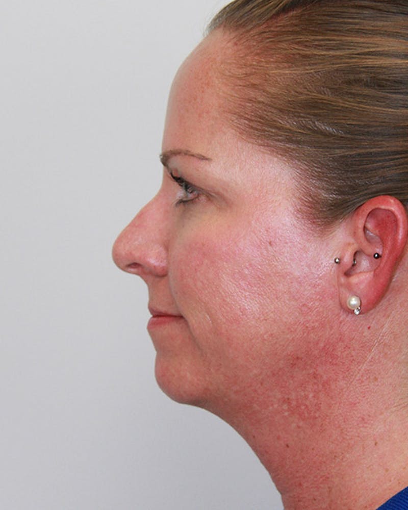 Rhinoplasty Before & After Gallery - Patient 143522143 - Image 7