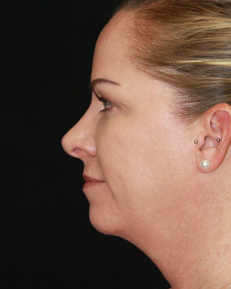 Rhinoplasty Before & After Gallery - Patient 143522143 - Image 8
