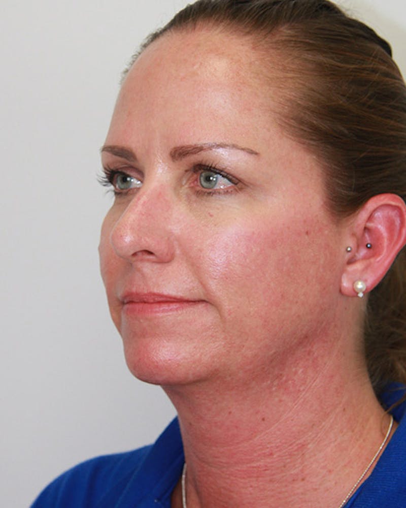 Rhinoplasty Before & After Gallery - Patient 143522143 - Image 9