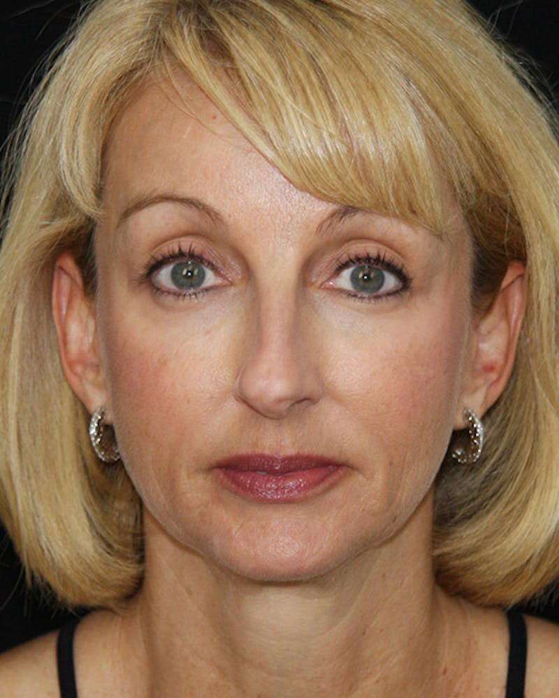 Rhinoplasty Before & After Gallery - Patient 143522147 - Image 1