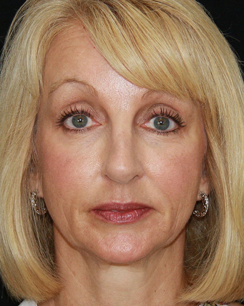 Rhinoplasty Before & After Gallery - Patient 143522147 - Image 2