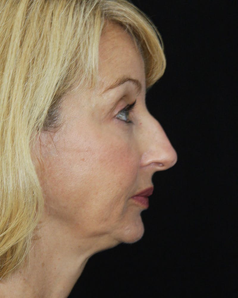 Rhinoplasty Before & After Gallery - Patient 143522147 - Image 3