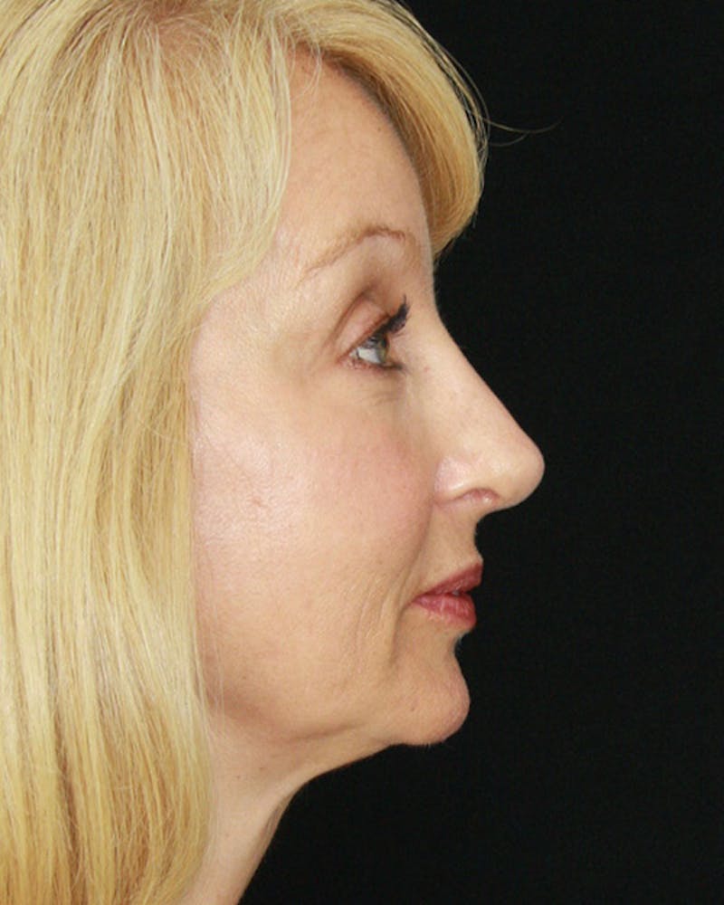 Rhinoplasty Before & After Gallery - Patient 143522147 - Image 4