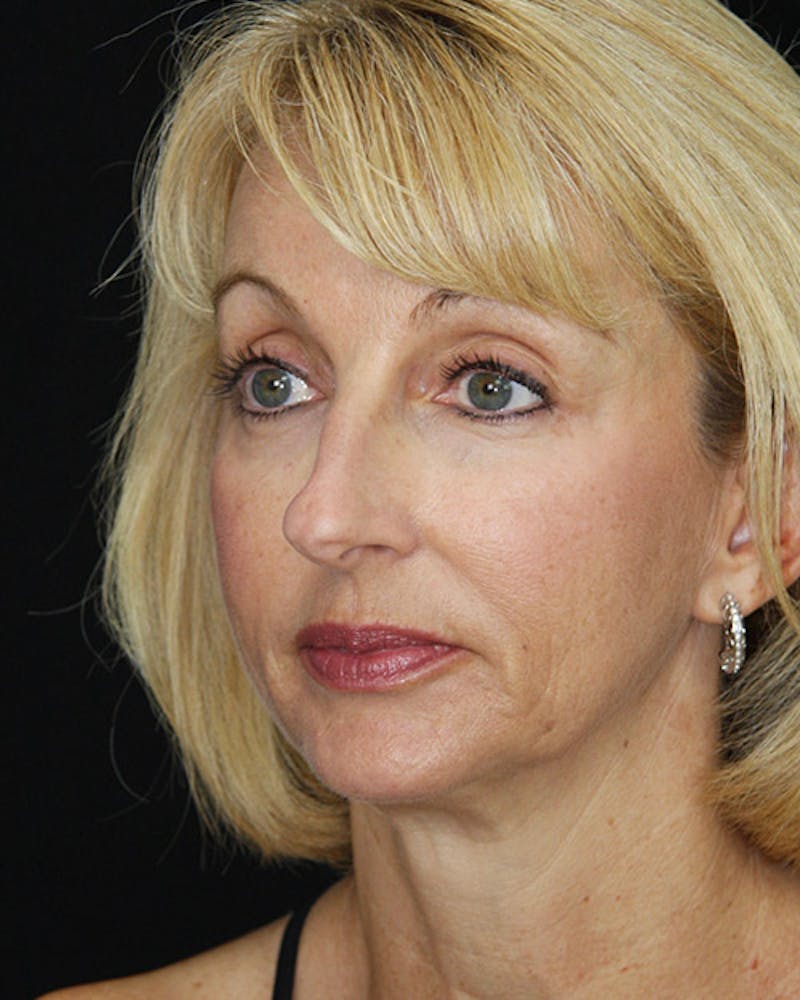 Rhinoplasty Before & After Gallery - Patient 143522147 - Image 5