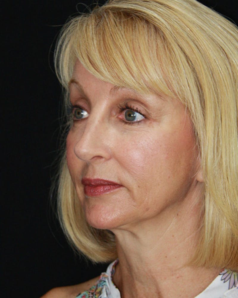 Rhinoplasty Before & After Gallery - Patient 143522147 - Image 6