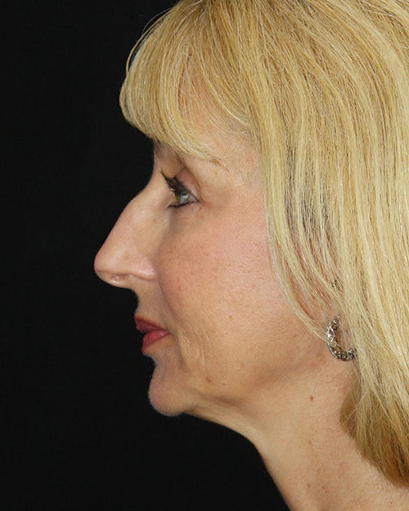 Rhinoplasty Before & After Gallery - Patient 143522147 - Image 7