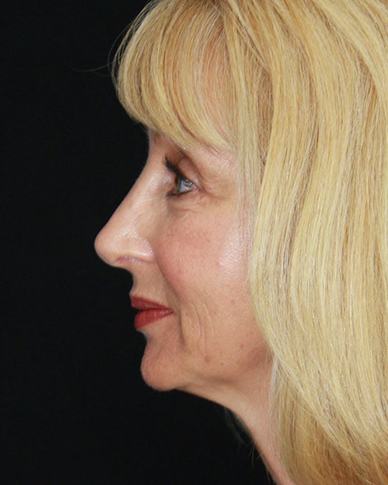 Rhinoplasty Before & After Gallery - Patient 143522147 - Image 8