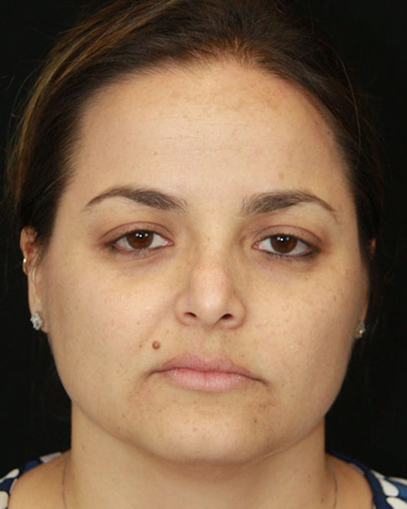 Rhinoplasty Before & After Gallery - Patient 143522149 - Image 1