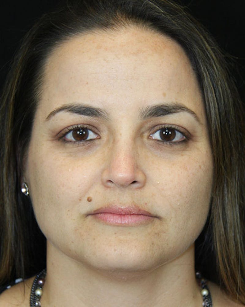 Rhinoplasty Before & After Gallery - Patient 143522149 - Image 2