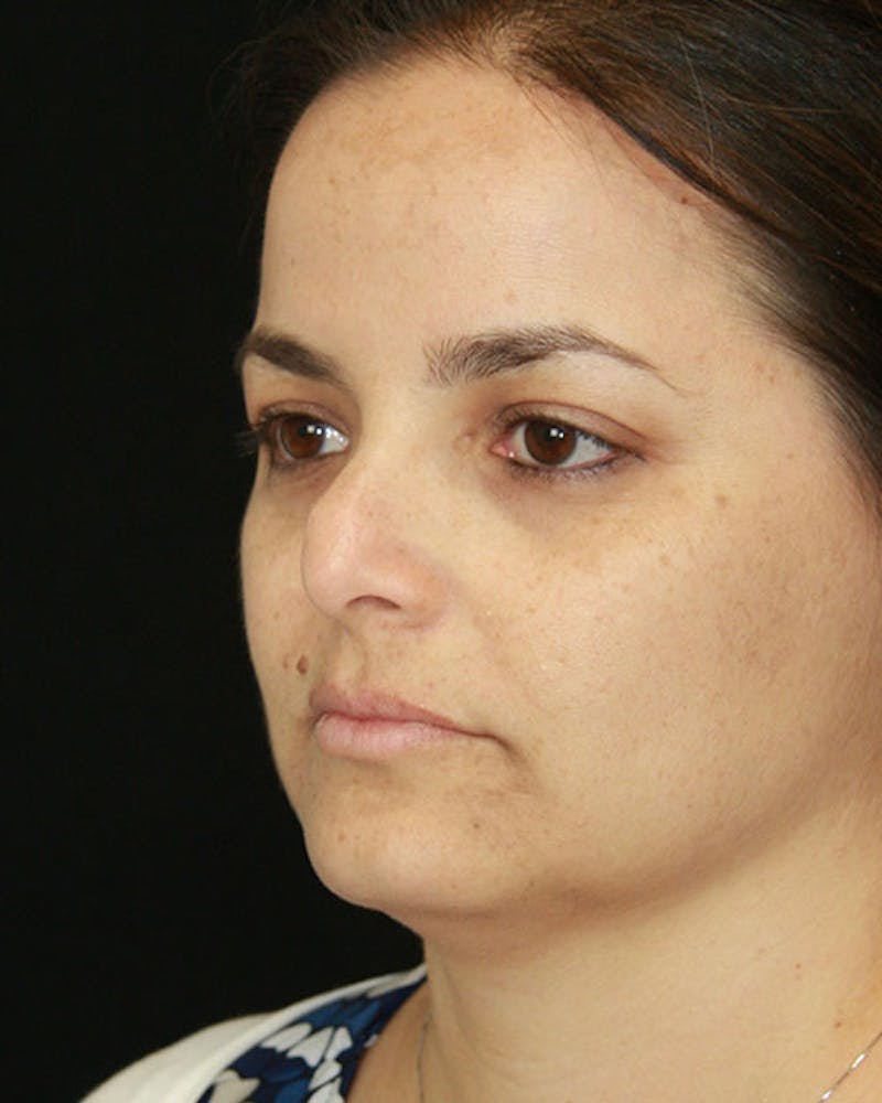 Rhinoplasty Before & After Gallery - Patient 143522149 - Image 5