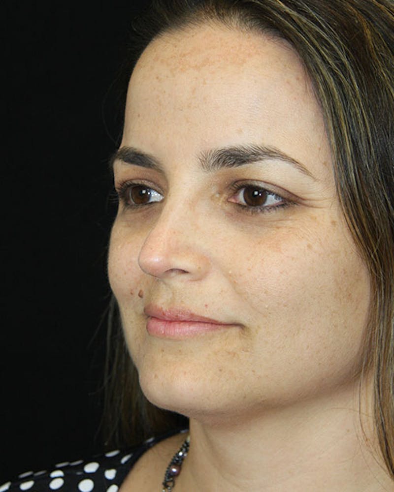 Rhinoplasty Before & After Gallery - Patient 143522149 - Image 6