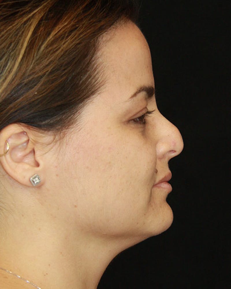 Rhinoplasty Before & After Gallery - Patient 143522149 - Image 7