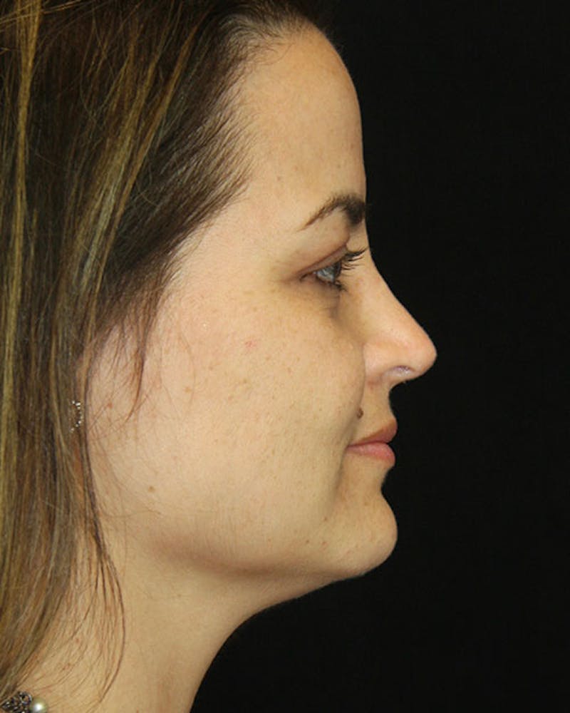 Rhinoplasty Before & After Gallery - Patient 143522149 - Image 8