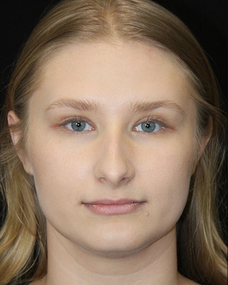 Rhinoplasty Before & After Gallery - Patient 143522152 - Image 1
