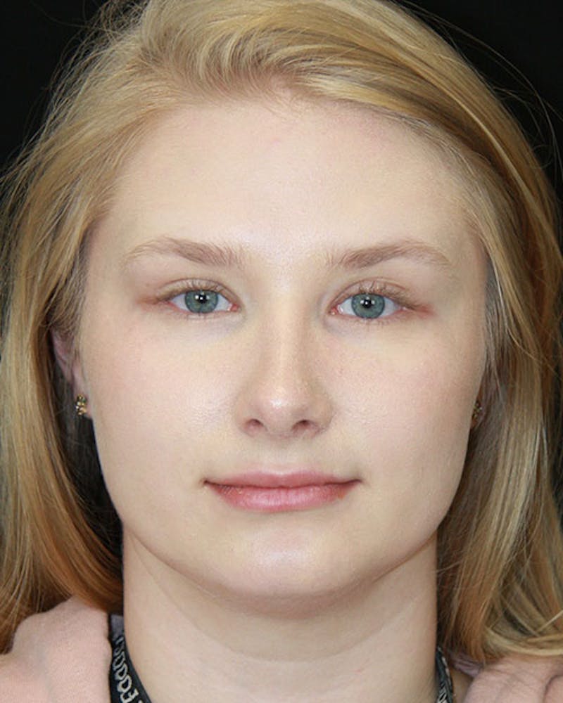 Rhinoplasty Before & After Gallery - Patient 143522152 - Image 2