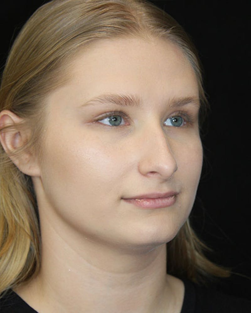 Rhinoplasty Before & After Gallery - Patient 143522152 - Image 3