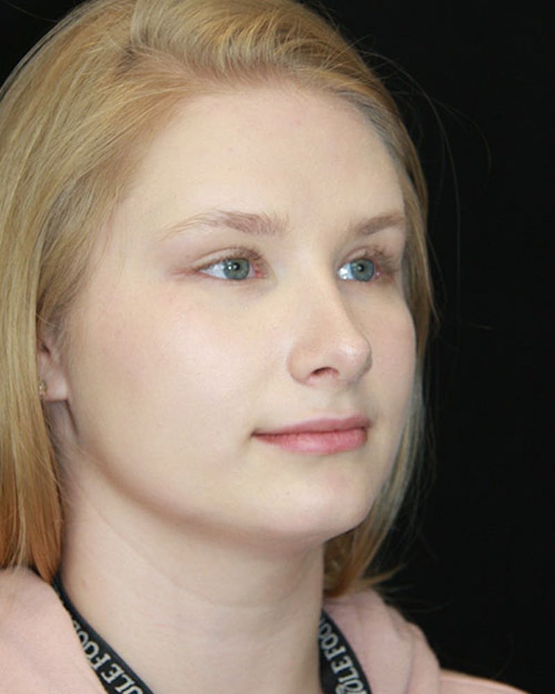 Rhinoplasty Before & After Gallery - Patient 143522152 - Image 4