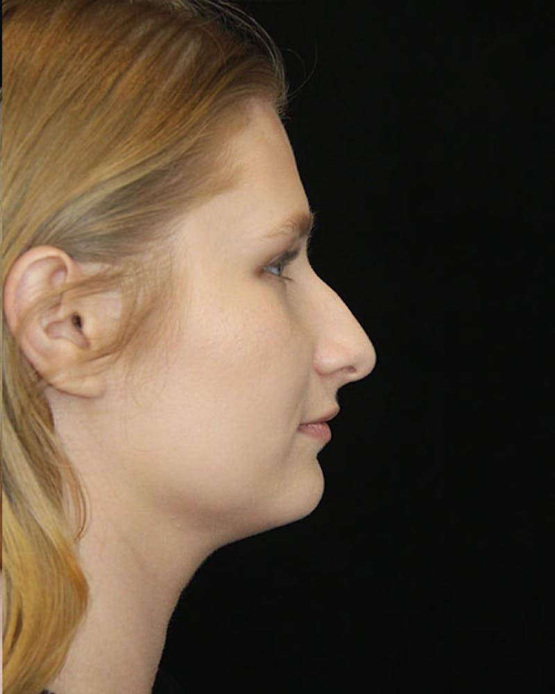 Rhinoplasty Before & After Gallery - Patient 143522152 - Image 5