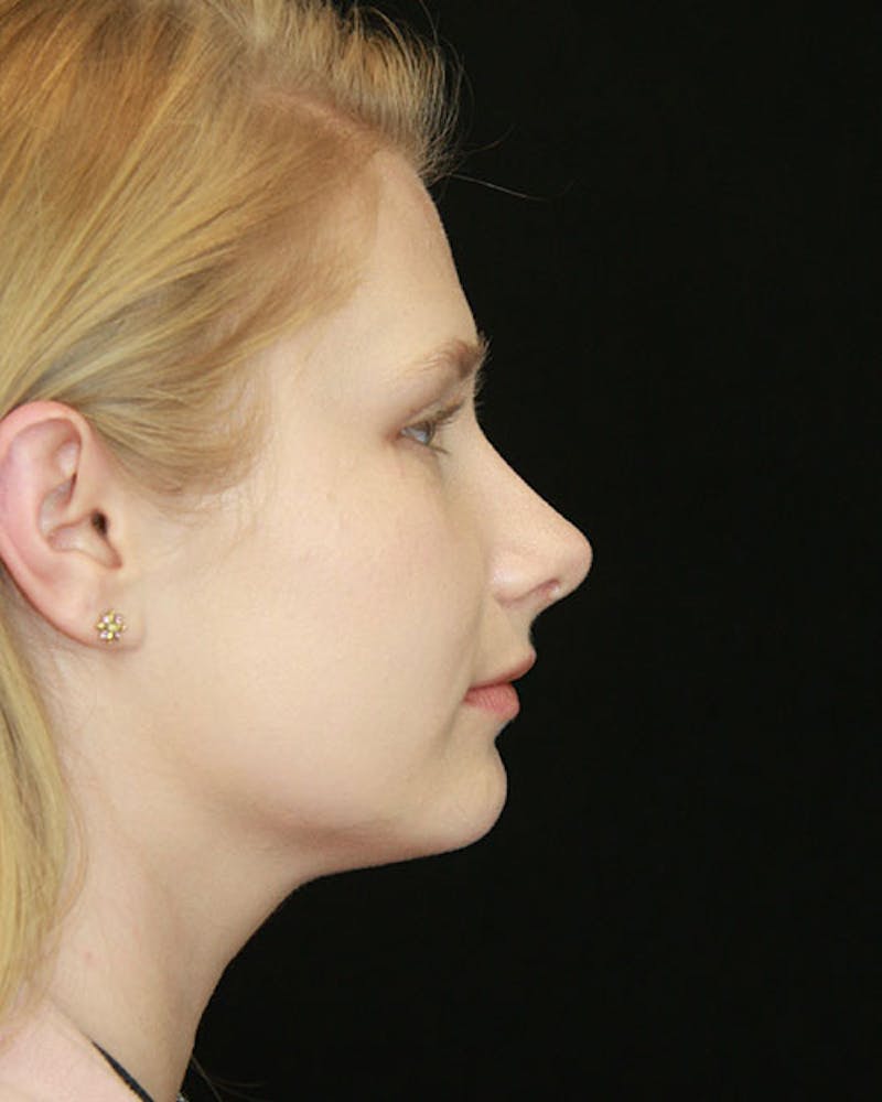 Rhinoplasty Before & After Gallery - Patient 143522152 - Image 6