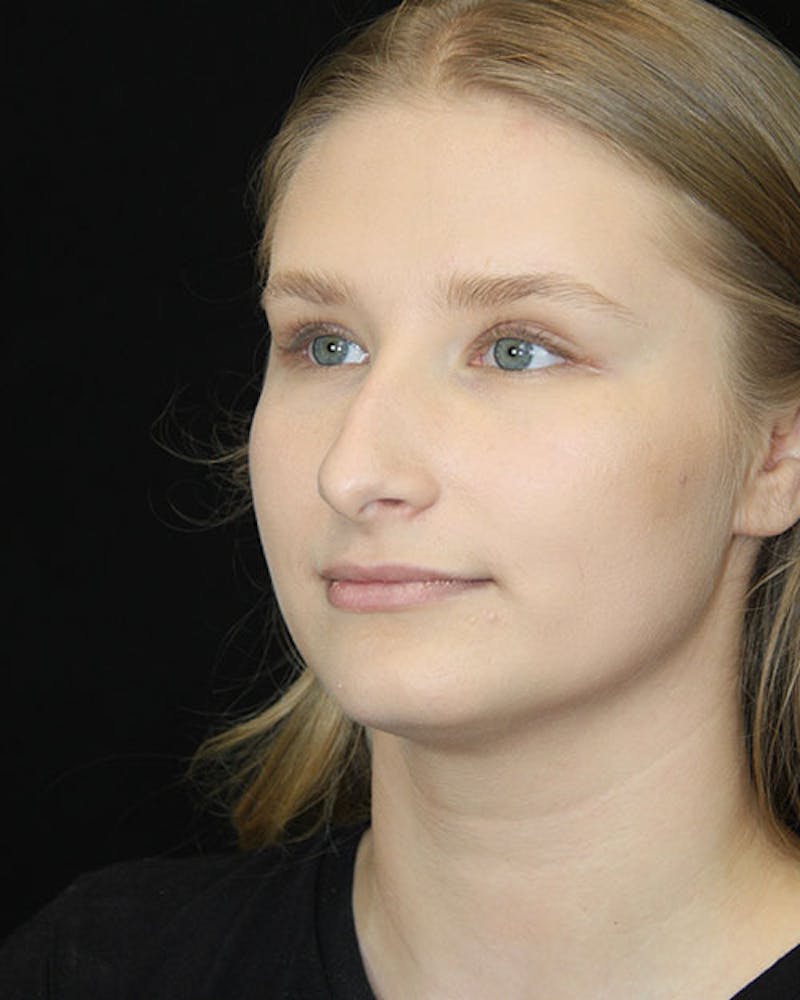 Rhinoplasty Before & After Gallery - Patient 143522152 - Image 7