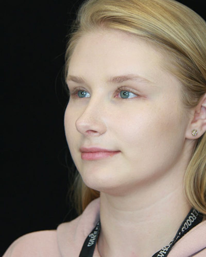 Rhinoplasty Before & After Gallery - Patient 143522152 - Image 8