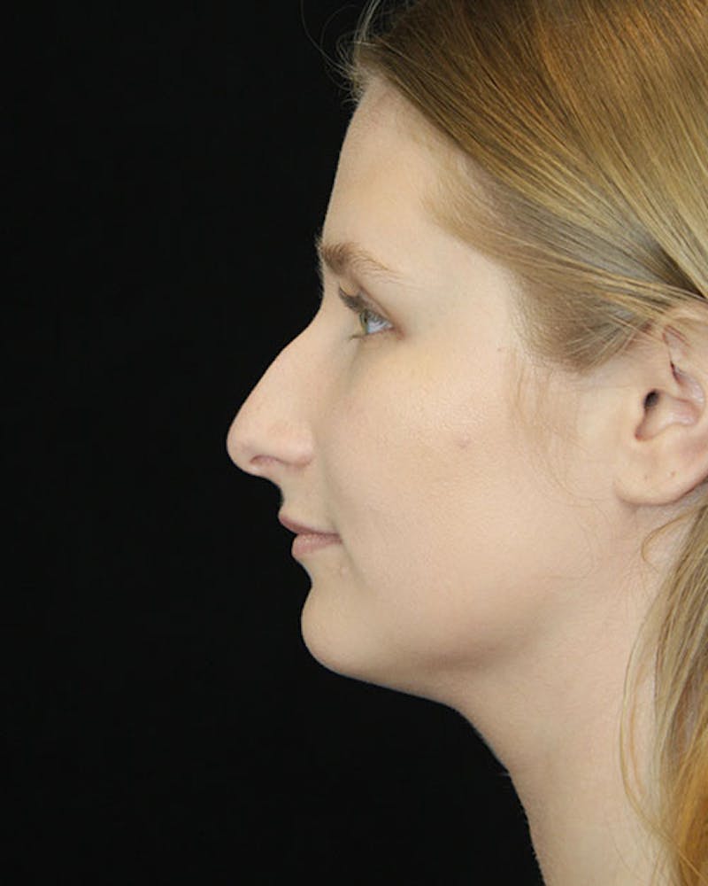 Rhinoplasty Before & After Gallery - Patient 143522152 - Image 9