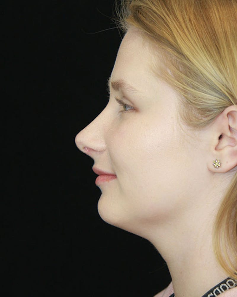 Rhinoplasty Before & After Gallery - Patient 143522152 - Image 10