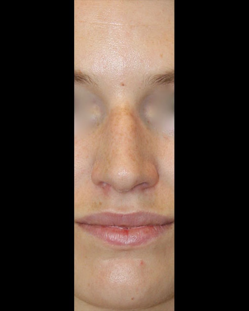 Rhinoplasty Before & After Gallery - Patient 143522154 - Image 1