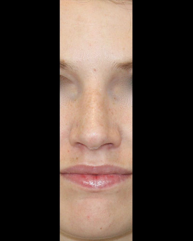 Rhinoplasty Before & After Gallery - Patient 143522154 - Image 2