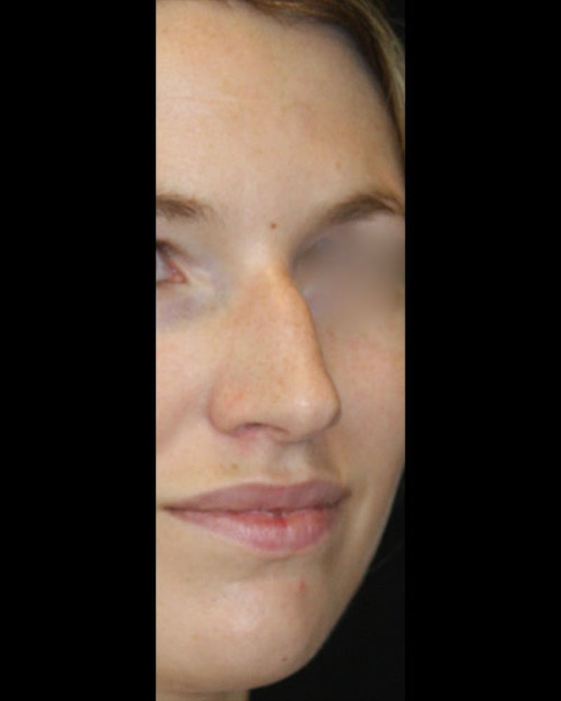 Rhinoplasty Before & After Gallery - Patient 143522154 - Image 3