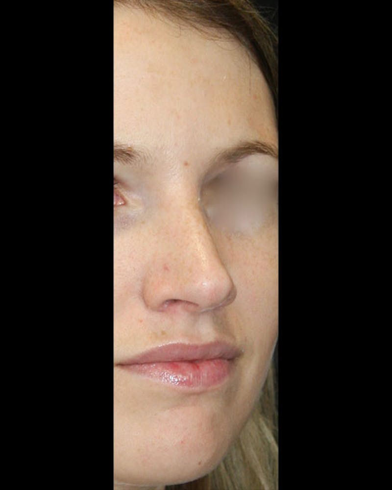 Rhinoplasty Before & After Gallery - Patient 143522154 - Image 4