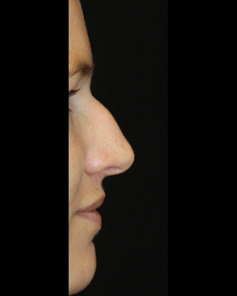 Rhinoplasty Before & After Gallery - Patient 143522154 - Image 5