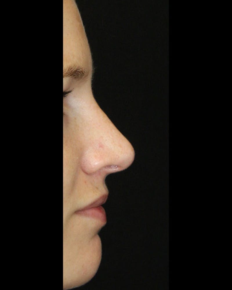 Rhinoplasty Before & After Gallery - Patient 143522154 - Image 6