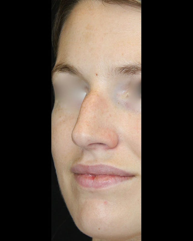 Rhinoplasty Before & After Gallery - Patient 143522154 - Image 7