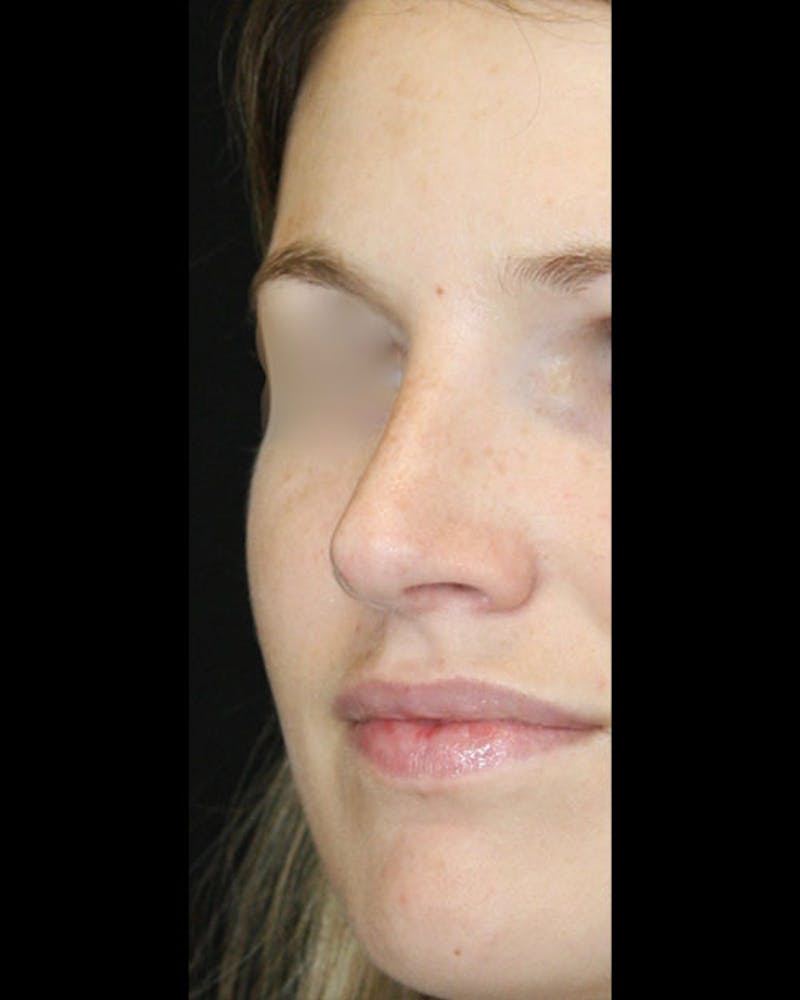 Rhinoplasty Before & After Gallery - Patient 143522154 - Image 8