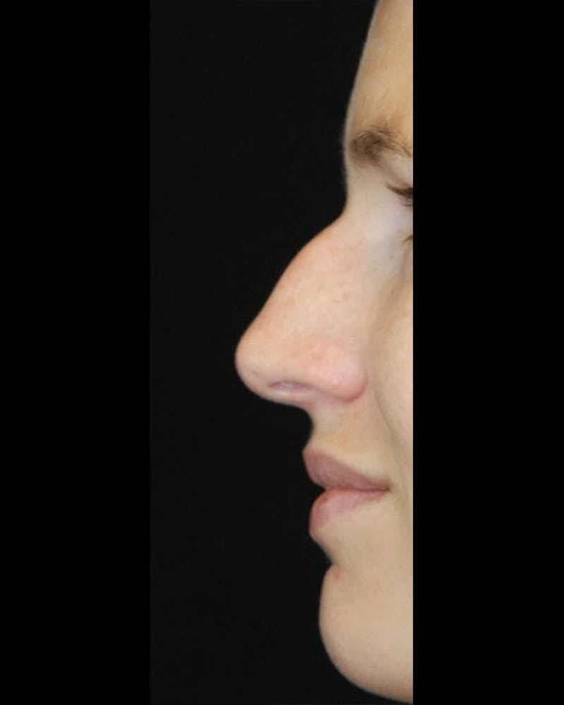 Rhinoplasty Before & After Gallery - Patient 143522154 - Image 9