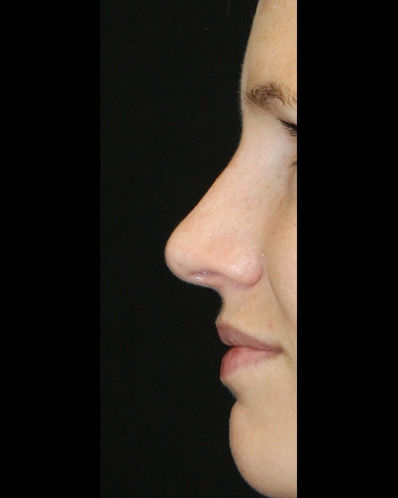 Rhinoplasty Before & After Gallery - Patient 143522154 - Image 10