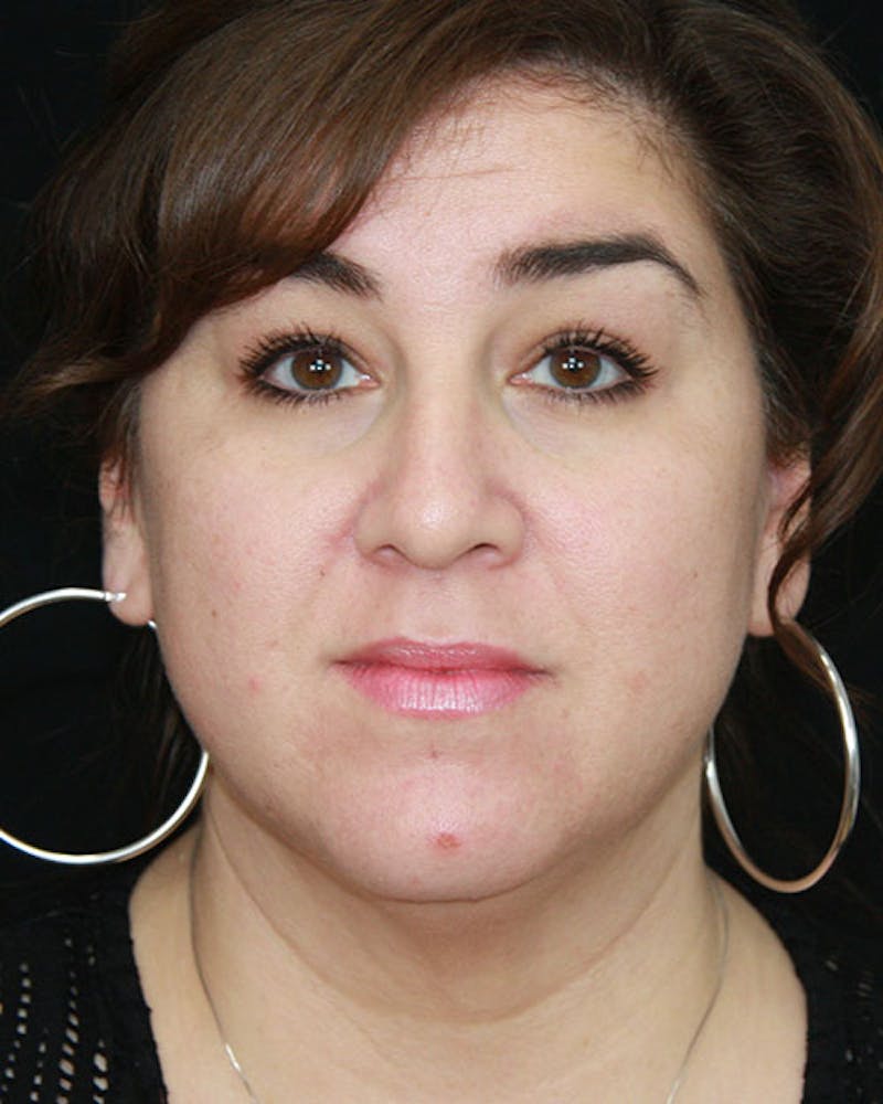 Rhinoplasty Before & After Gallery - Patient 143522155 - Image 1