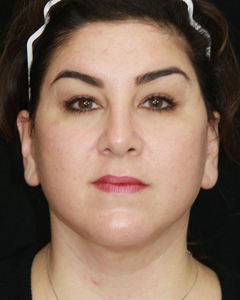 Rhinoplasty Before & After Gallery - Patient 143522155 - Image 2