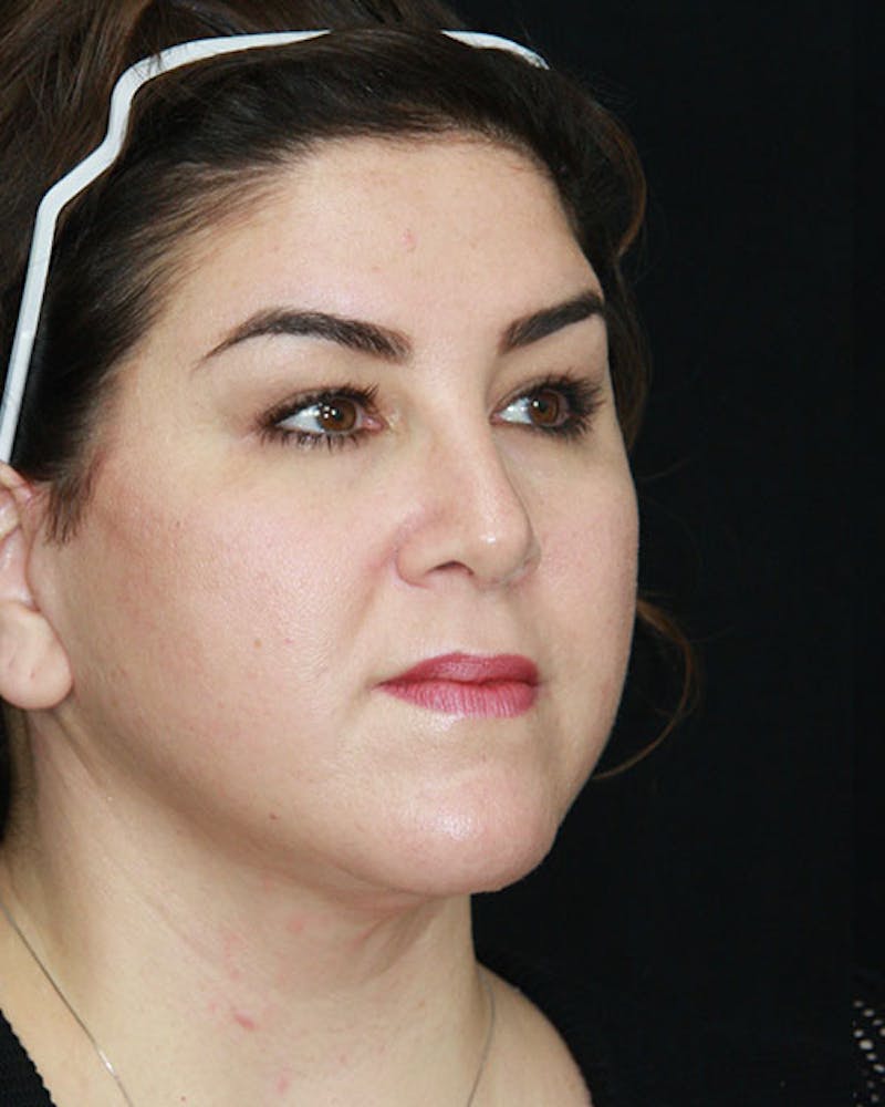 Rhinoplasty Before & After Gallery - Patient 143522155 - Image 4