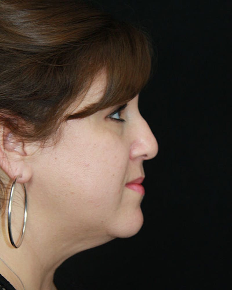 Rhinoplasty Before & After Gallery - Patient 143522155 - Image 5