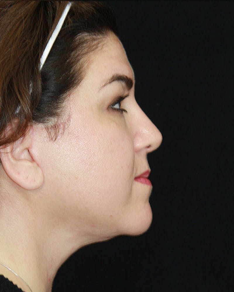 Rhinoplasty Before & After Gallery - Patient 143522155 - Image 6