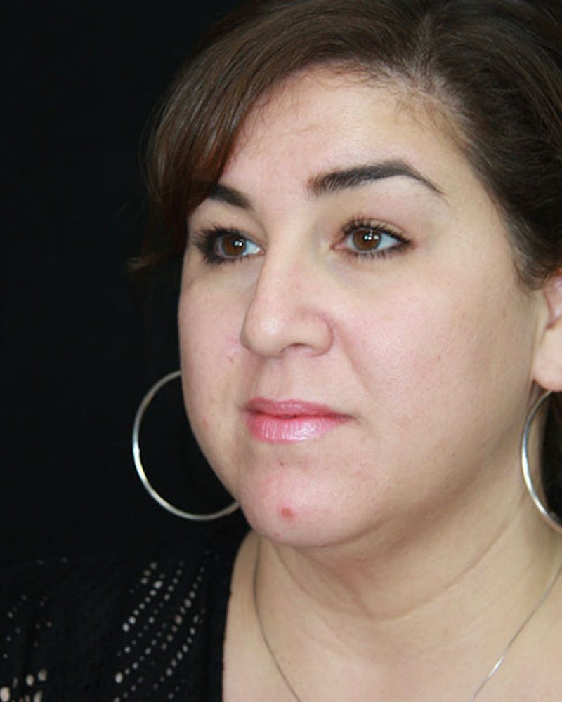 Rhinoplasty Before & After Gallery - Patient 143522155 - Image 7