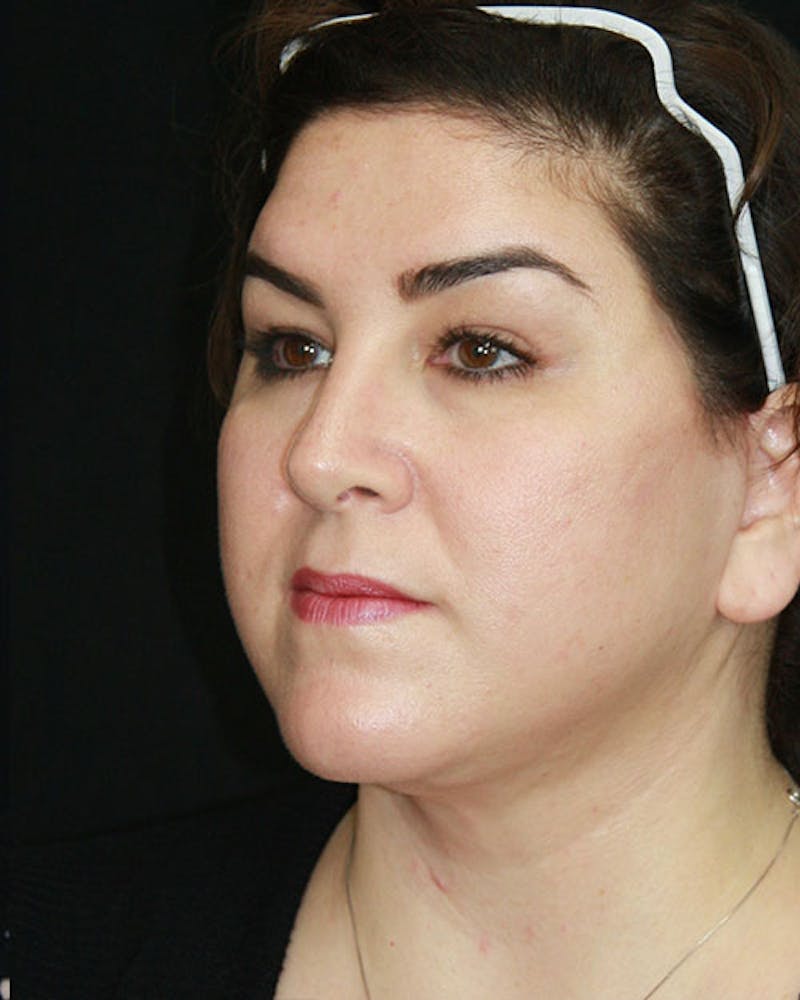 Rhinoplasty Before & After Gallery - Patient 143522155 - Image 8