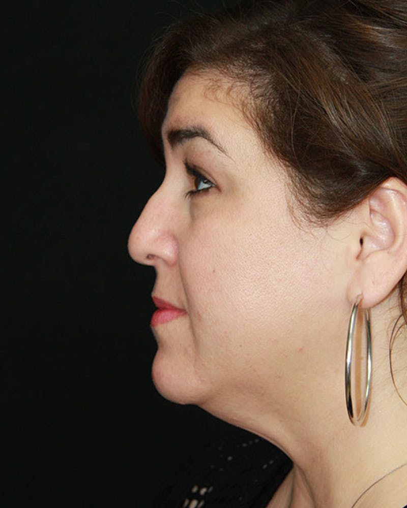 Rhinoplasty Before & After Gallery - Patient 143522155 - Image 9