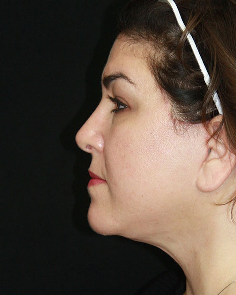 Rhinoplasty Before & After Gallery - Patient 143522155 - Image 10